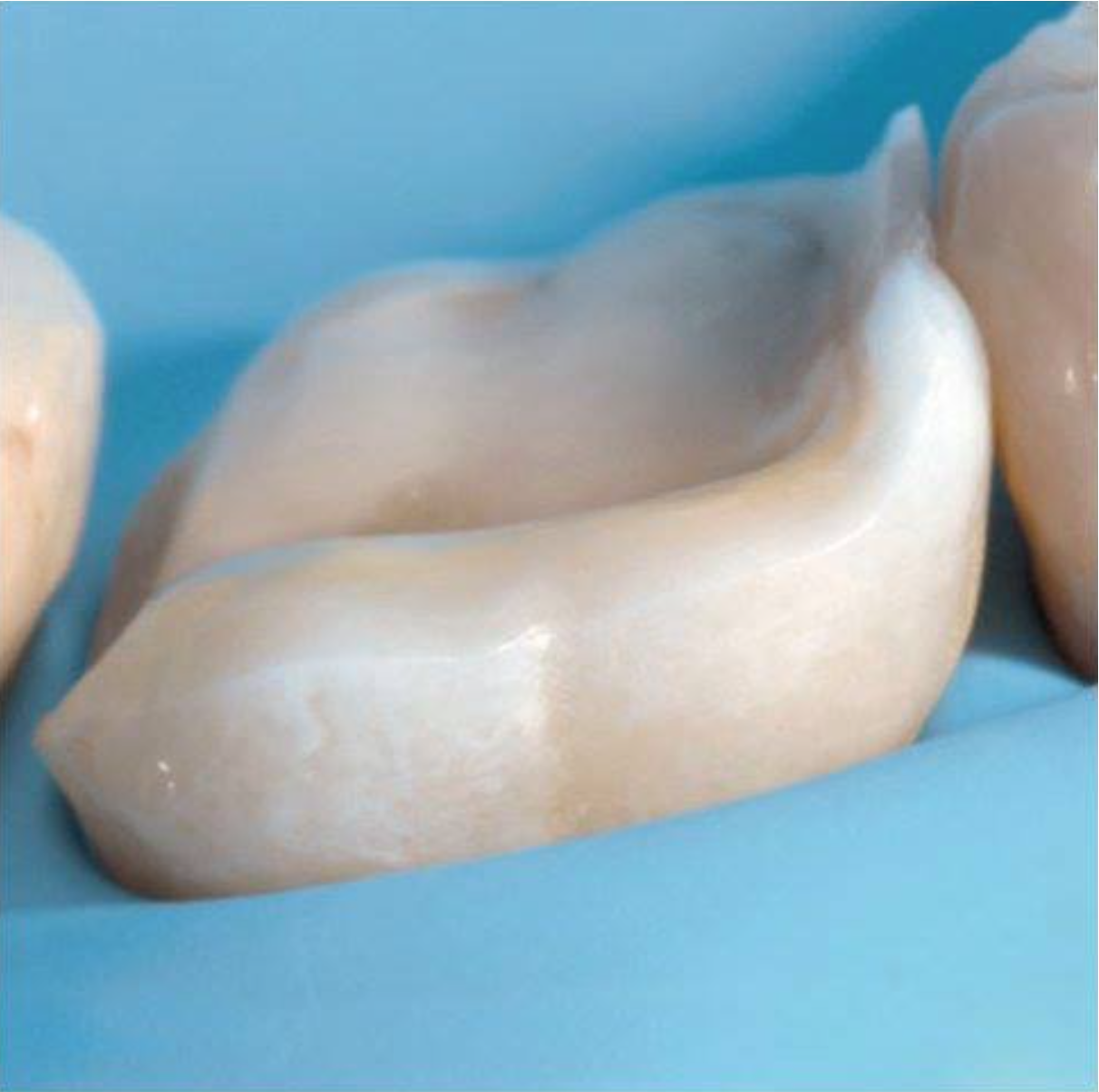¿Qué es una incrustación dental?             Inlays, onlays & overlays.