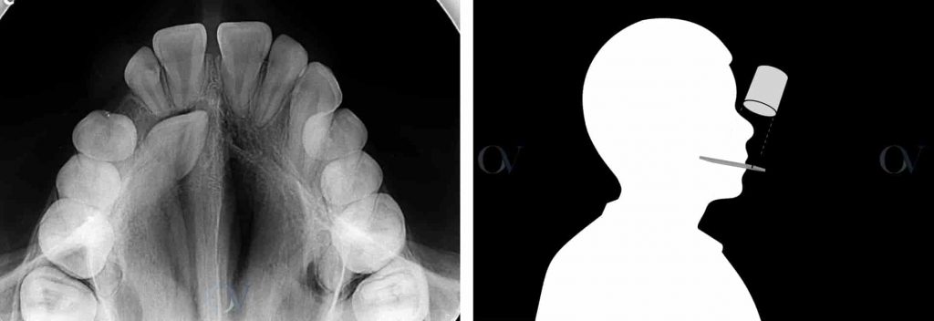 radiografía oclusal maxilar