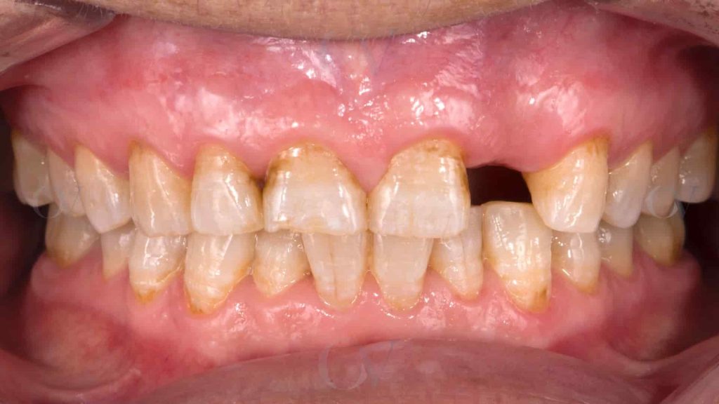 Ausencia de diente 2.2
