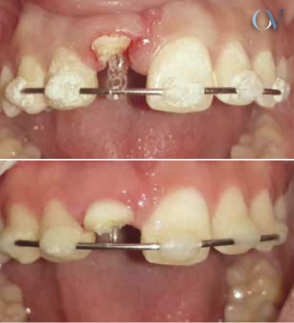 ᐈ El Ferrule dental o efecto ferrule ⭐