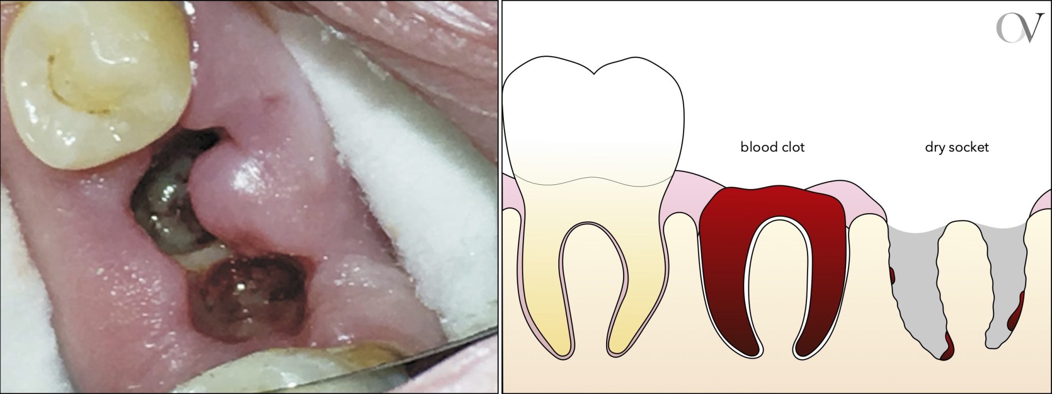 ᐈ Alveolitis Seca Diagnóstico, tratamiento y prevención ⭐